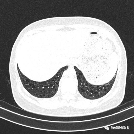 影像PPT - 【病例】中年女性,探秘双肺弥漫性囊腔-151 影像PPT - 【病例】中年女性,探秘双肺弥漫性囊腔-151