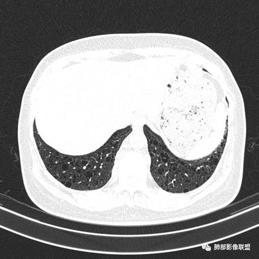 影像PPT - 【病例】中年女性,探秘双肺弥漫性囊腔-148 影像PPT - 【病例】中年女性,探秘双肺弥漫性囊腔-148