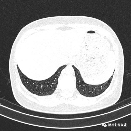 影像PPT - 【病例】中年女性,探秘双肺弥漫性囊腔-153 影像PPT - 【病例】中年女性,探秘双肺弥漫性囊腔-153