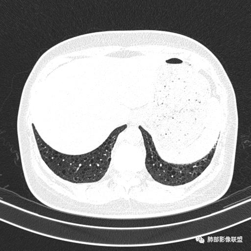 影像PPT - 【病例】中年女性,探秘双肺弥漫性囊腔-154 影像PPT - 【病例】中年女性,探秘双肺弥漫性囊腔-154