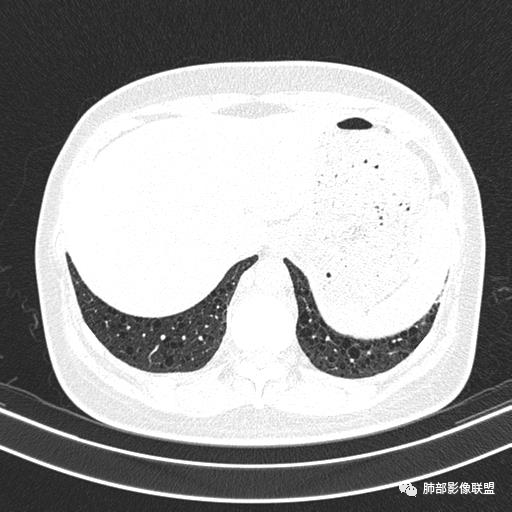 影像PPT - 【病例】中年女性,探秘双肺弥漫性囊腔-155 影像PPT - 【病例】中年女性,探秘双肺弥漫性囊腔-155