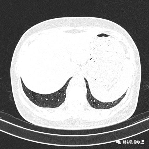 影像PPT - 【病例】中年女性,探秘双肺弥漫性囊腔-158 影像PPT - 【病例】中年女性,探秘双肺弥漫性囊腔-158