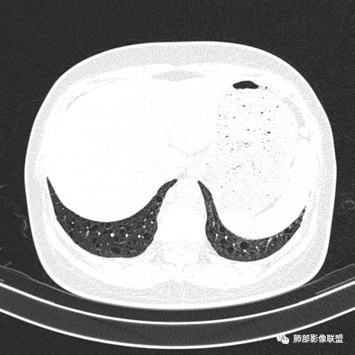 影像PPT - 【病例】中年女性,探秘双肺弥漫性囊腔-156 影像PPT - 【病例】中年女性,探秘双肺弥漫性囊腔-156
