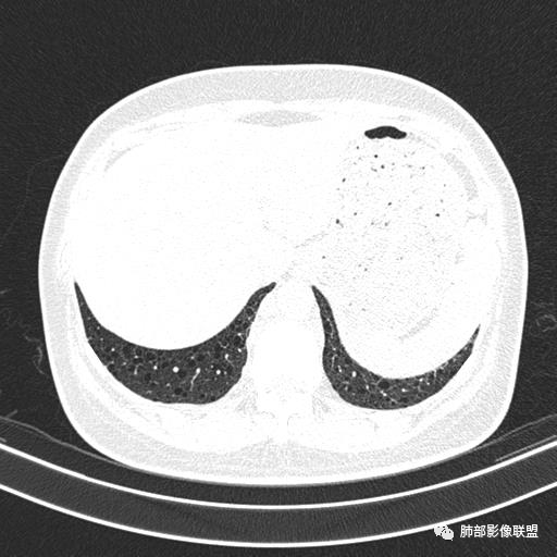 影像PPT - 【病例】中年女性,探秘双肺弥漫性囊腔-157 影像PPT - 【病例】中年女性,探秘双肺弥漫性囊腔-157