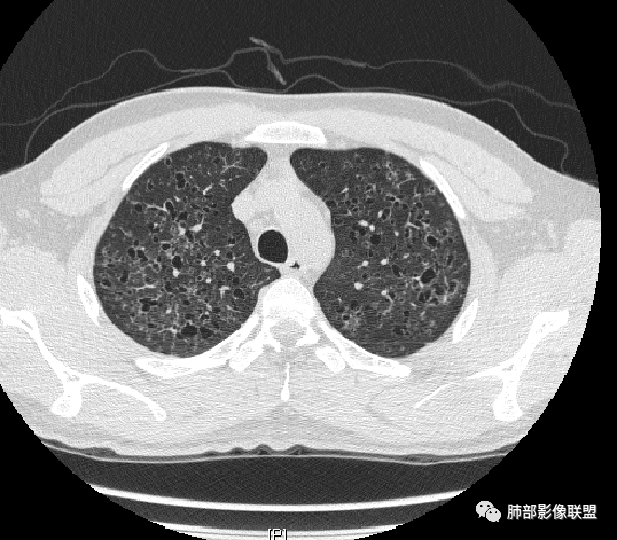 影像PPT - 【病例】中年女性,探秘双肺弥漫性囊腔-165 影像PPT - 【病例】中年女性,探秘双肺弥漫性囊腔-165
