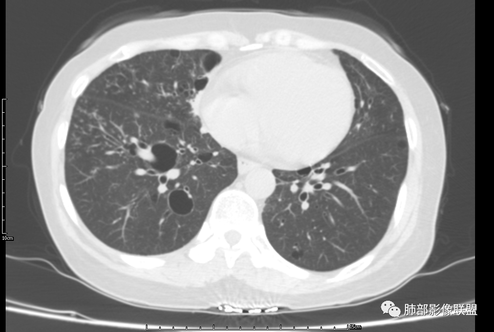 影像PPT - 【病例】中年女性,探秘双肺弥漫性囊腔-166 影像PPT - 【病例】中年女性,探秘双肺弥漫性囊腔-166