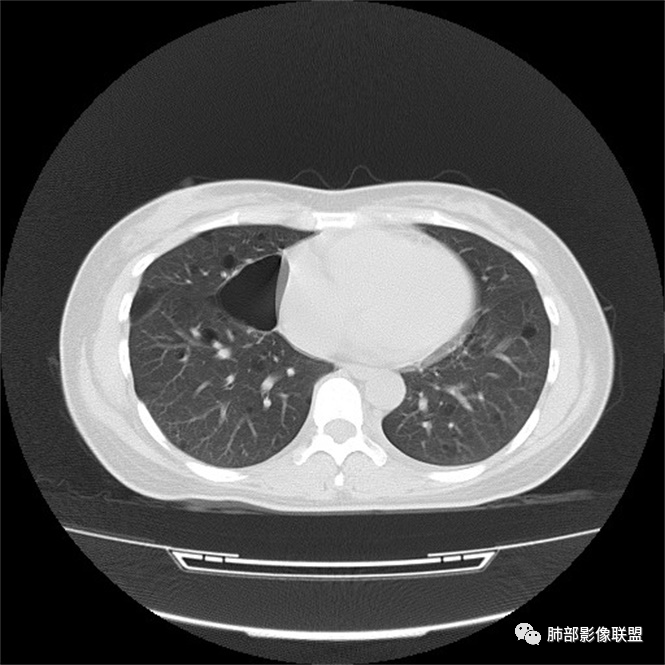 影像PPT - 【病例】中年女性,探秘双肺弥漫性囊腔-167 影像PPT - 【病例】中年女性,探秘双肺弥漫性囊腔-167