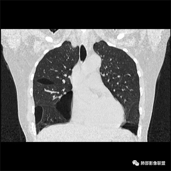 影像PPT - 【病例】中年女性,探秘双肺弥漫性囊腔-168 影像PPT - 【病例】中年女性,探秘双肺弥漫性囊腔-168