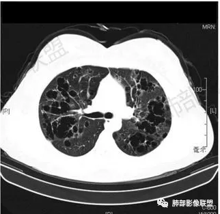 影像PPT - 【病例】中年女性,探秘双肺弥漫性囊腔-169 影像PPT - 【病例】中年女性,探秘双肺弥漫性囊腔-169