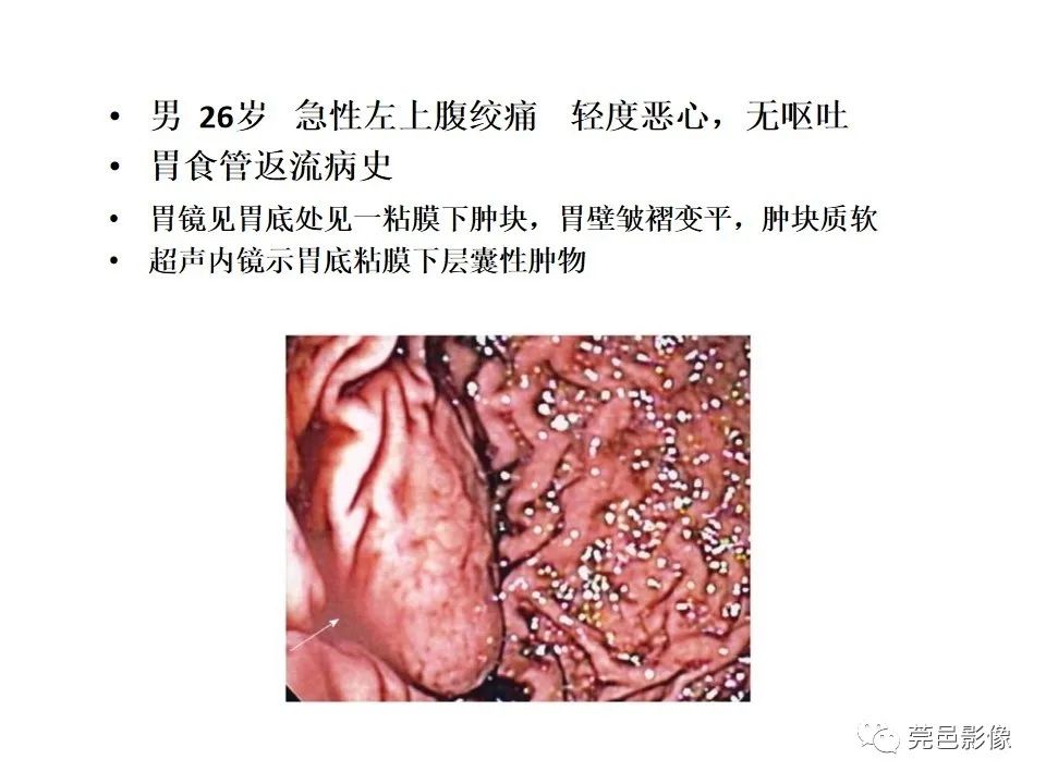 影像PPT - 【PPT】胃重复畸形-2 影像PPT - 【PPT】胃重复畸形-2