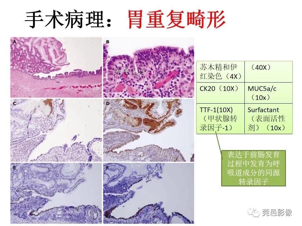 影像PPT - 【PPT】胃重复畸形-6 影像PPT - 【PPT】胃重复畸形-6