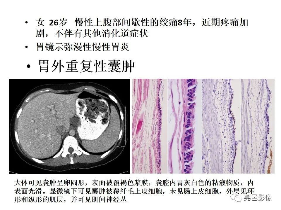 影像PPT - 【PPT】胃重复畸形-14 影像PPT - 【PPT】胃重复畸形-14