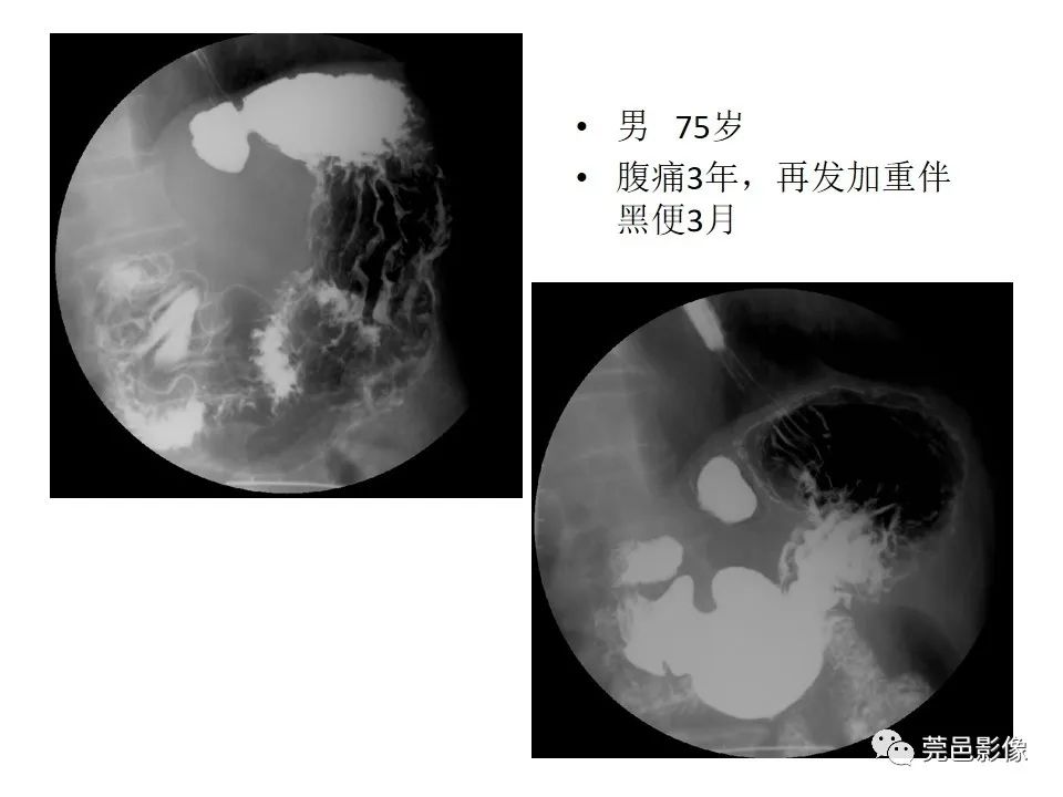 影像PPT - 【PPT】胃重复畸形-19 影像PPT - 【PPT】胃重复畸形-19