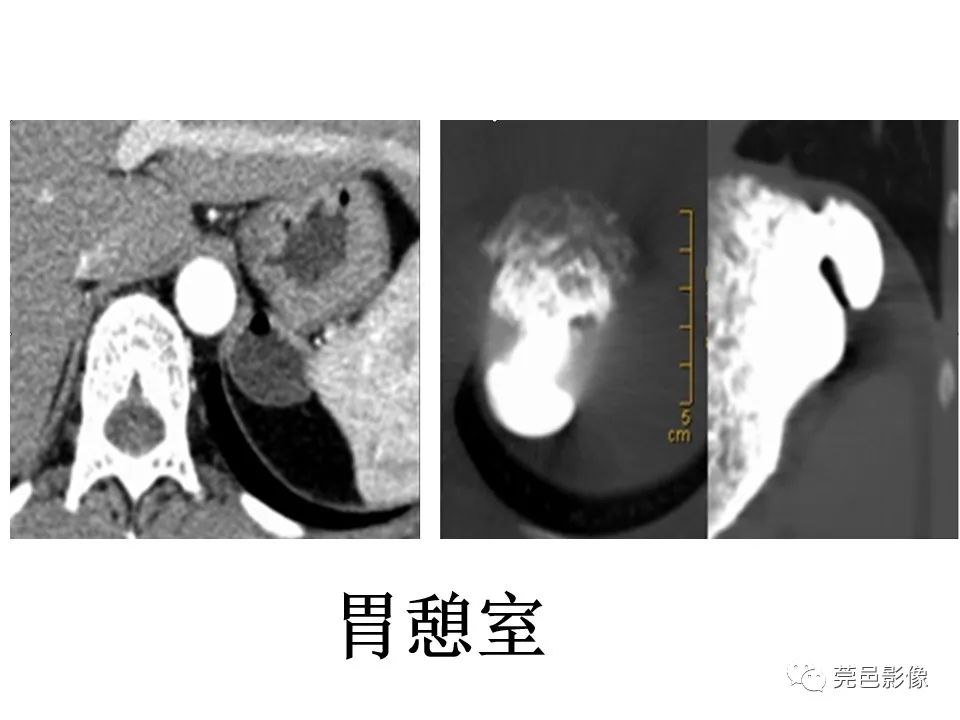 影像PPT - 【PPT】胃重复畸形-21 影像PPT - 【PPT】胃重复畸形-21