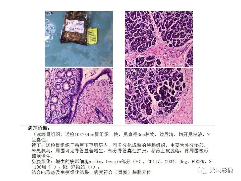 影像PPT - 【PPT】胃重复畸形-27 影像PPT - 【PPT】胃重复畸形-27