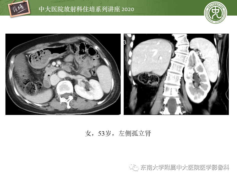 影像PPT - 【PPT】泌尿系统先天发育异常的影像表现-6