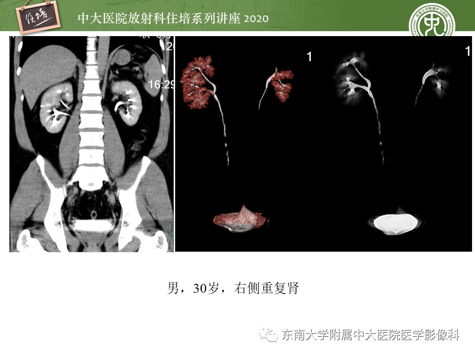 影像PPT - 【PPT】泌尿系统先天发育异常的影像表现-8