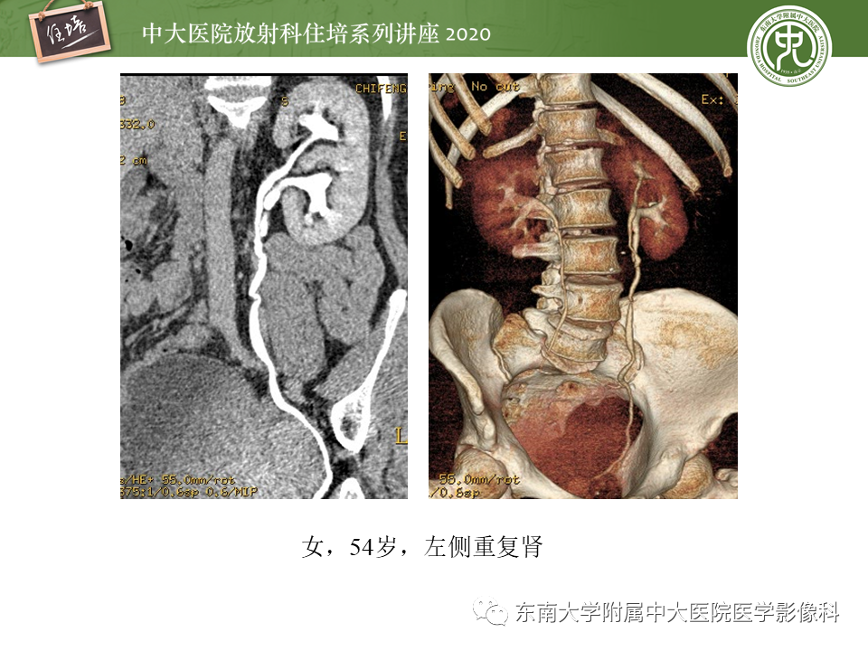 影像PPT - 【PPT】泌尿系统先天发育异常的影像表现-9