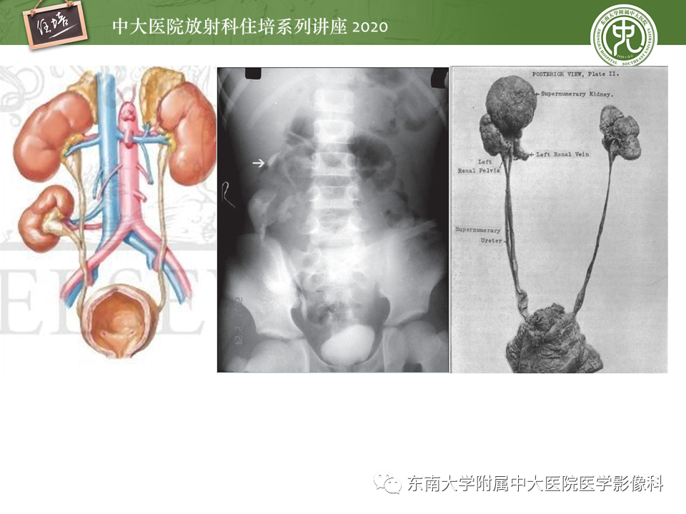 影像PPT - 【PPT】泌尿系统先天发育异常的影像表现-11