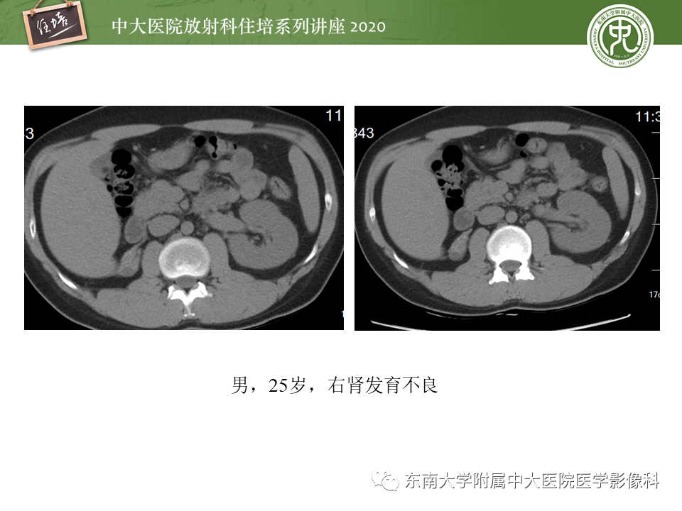 影像PPT - 【PPT】泌尿系统先天发育异常的影像表现-13