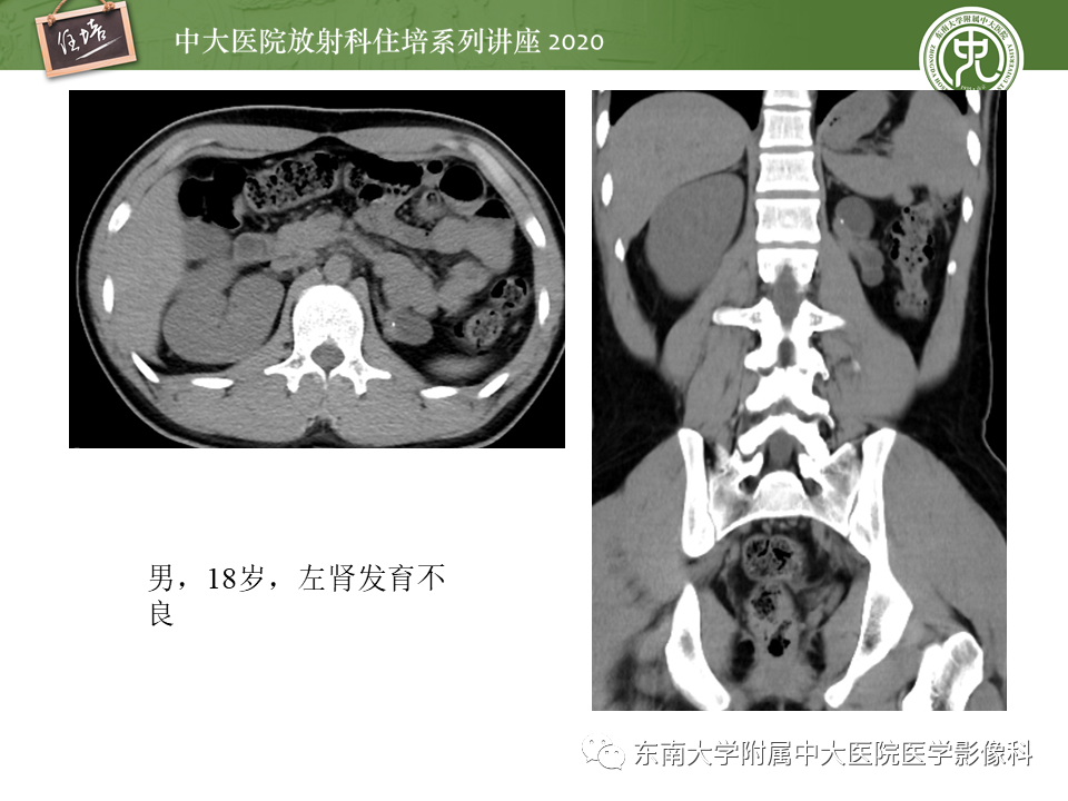 影像PPT - 【PPT】泌尿系统先天发育异常的影像表现-14