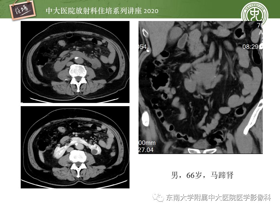 影像PPT - 【PPT】泌尿系统先天发育异常的影像表现-16