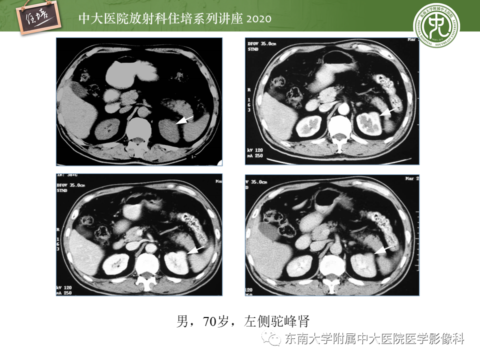 影像PPT - 【PPT】泌尿系统先天发育异常的影像表现-19