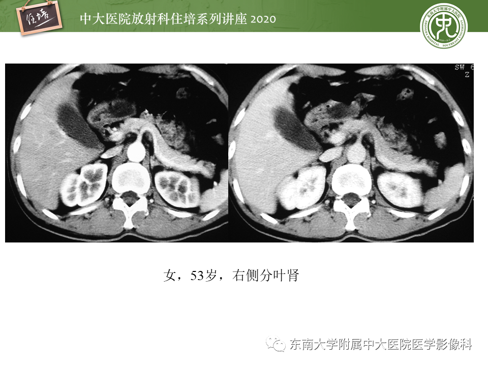 影像PPT - 【PPT】泌尿系统先天发育异常的影像表现-20