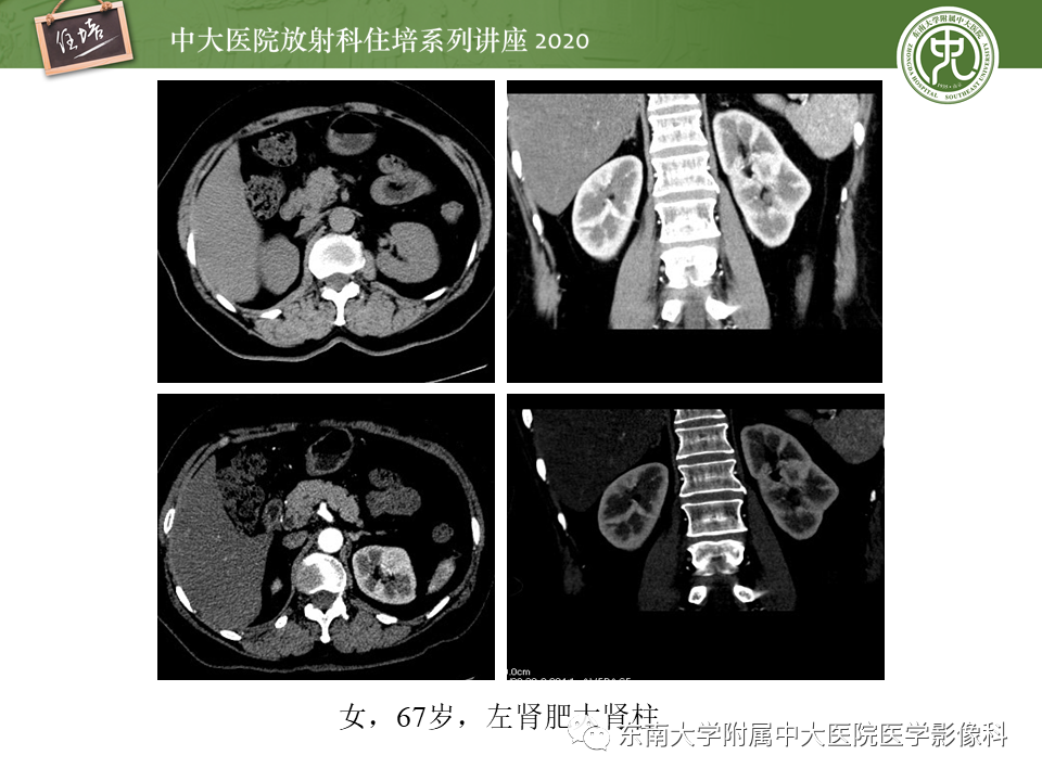 影像PPT - 【PPT】泌尿系统先天发育异常的影像表现-21