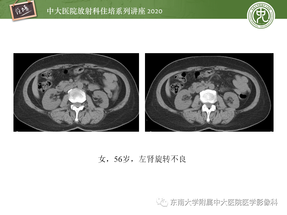 影像PPT - 【PPT】泌尿系统先天发育异常的影像表现-23