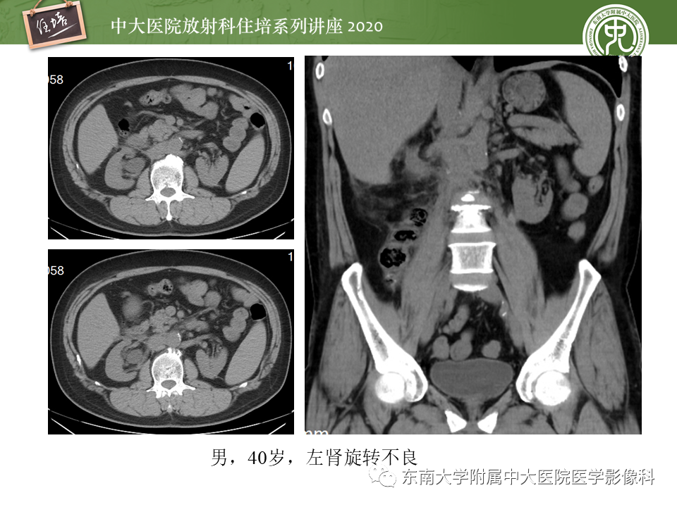 影像PPT - 【PPT】泌尿系统先天发育异常的影像表现-24
