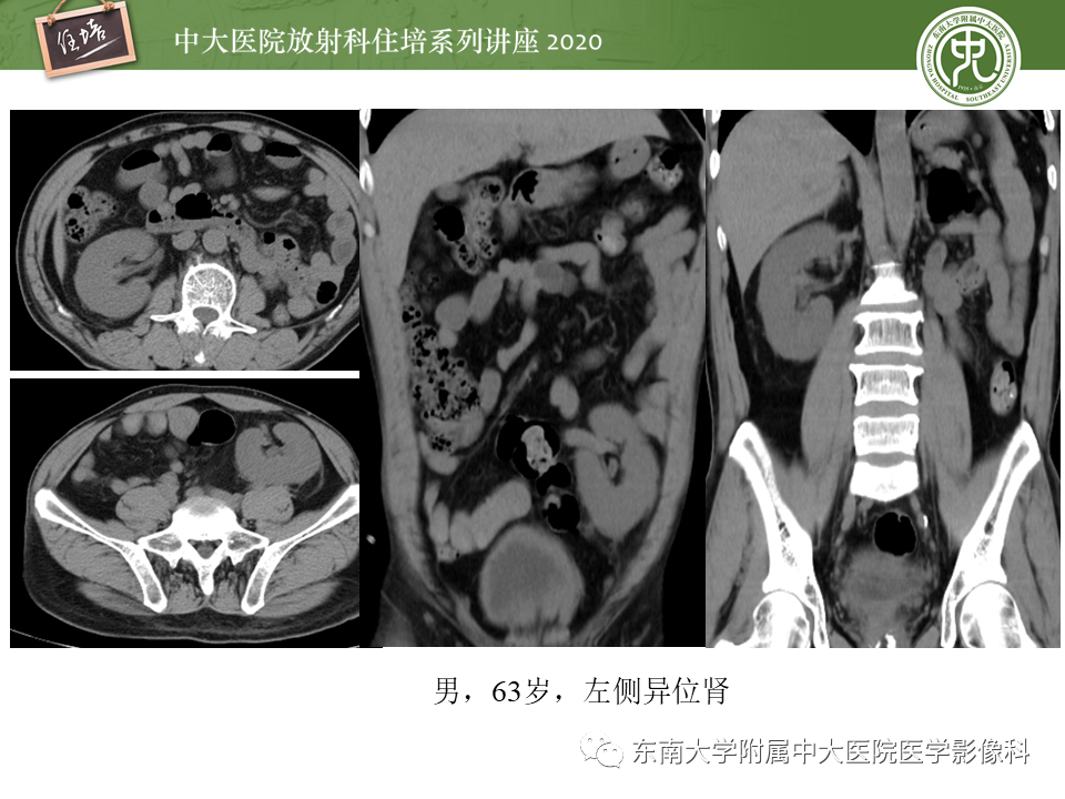 影像PPT - 【PPT】泌尿系统先天发育异常的影像表现-27
