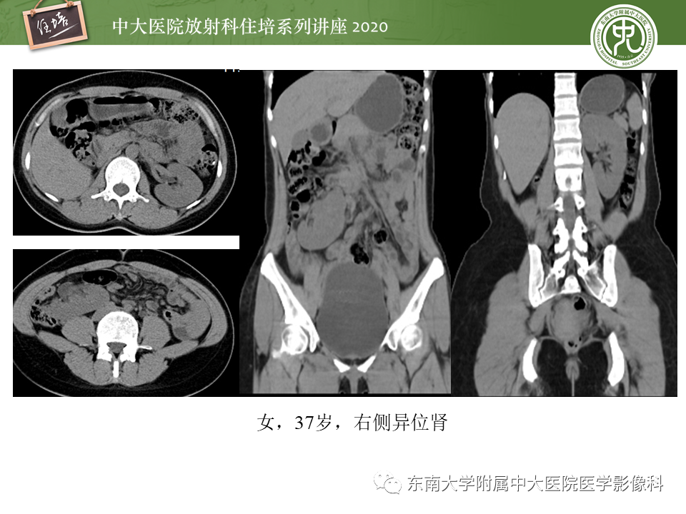影像PPT - 【PPT】泌尿系统先天发育异常的影像表现-26