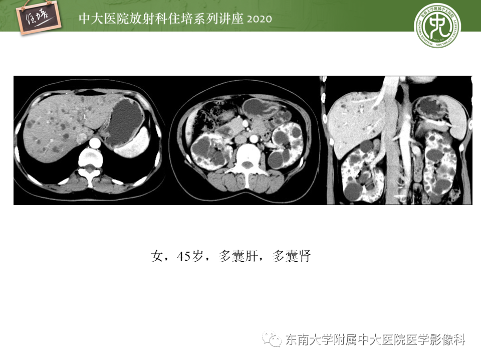 影像PPT - 【PPT】泌尿系统先天发育异常的影像表现-29
