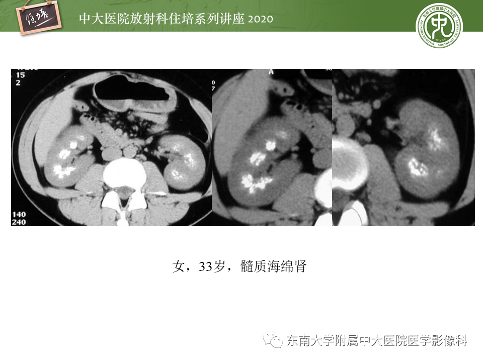 影像PPT - 【PPT】泌尿系统先天发育异常的影像表现-30