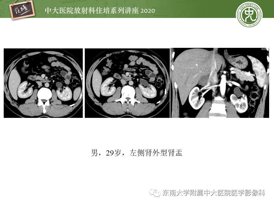 影像PPT - 【PPT】泌尿系统先天发育异常的影像表现-32