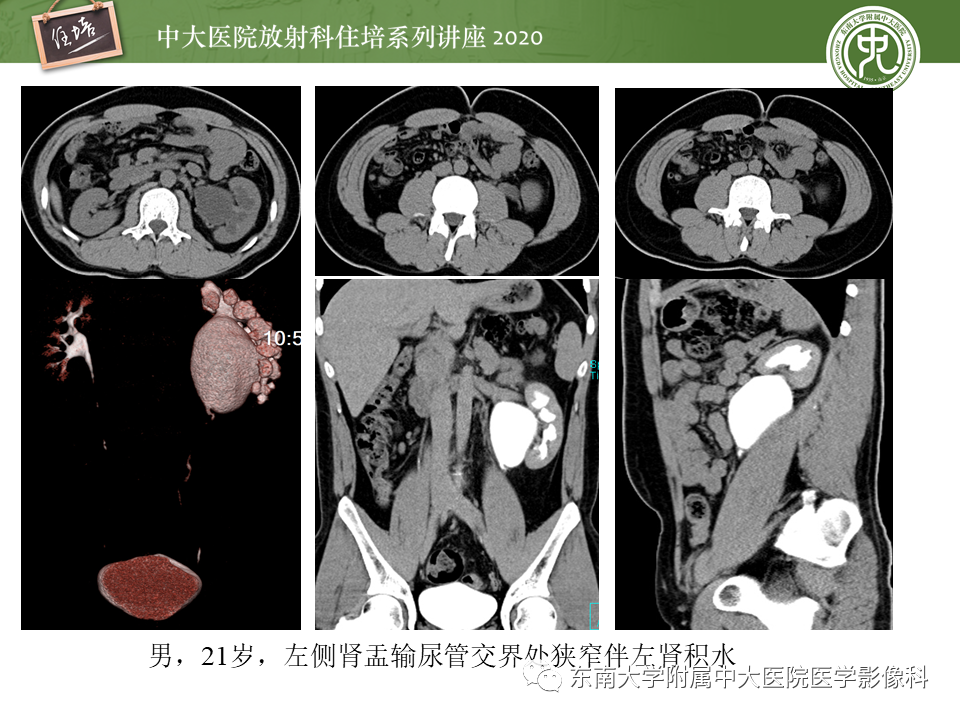 影像PPT - 【PPT】泌尿系统先天发育异常的影像表现-35