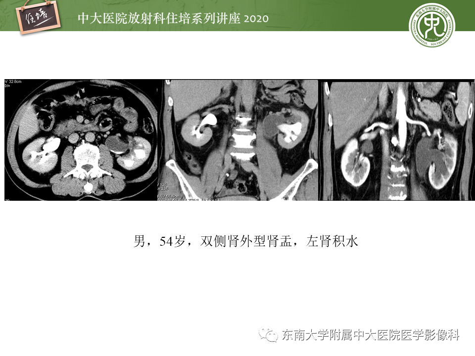 影像PPT - 【PPT】泌尿系统先天发育异常的影像表现-33