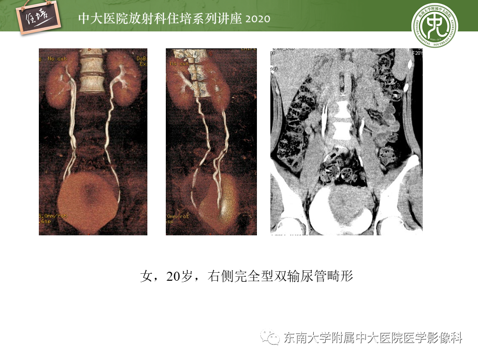 影像PPT - 【PPT】泌尿系统先天发育异常的影像表现-40