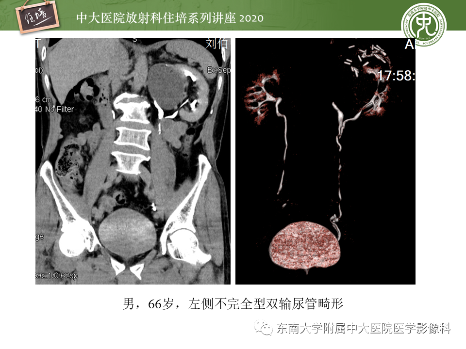 影像PPT - 【PPT】泌尿系统先天发育异常的影像表现-38