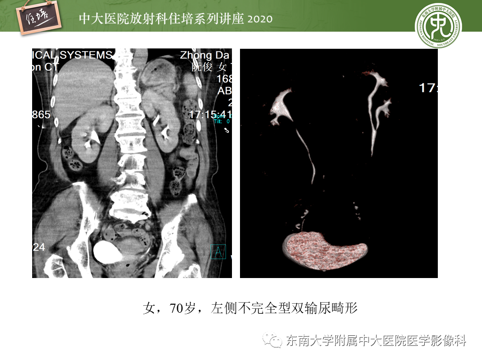 影像PPT - 【PPT】泌尿系统先天发育异常的影像表现-39