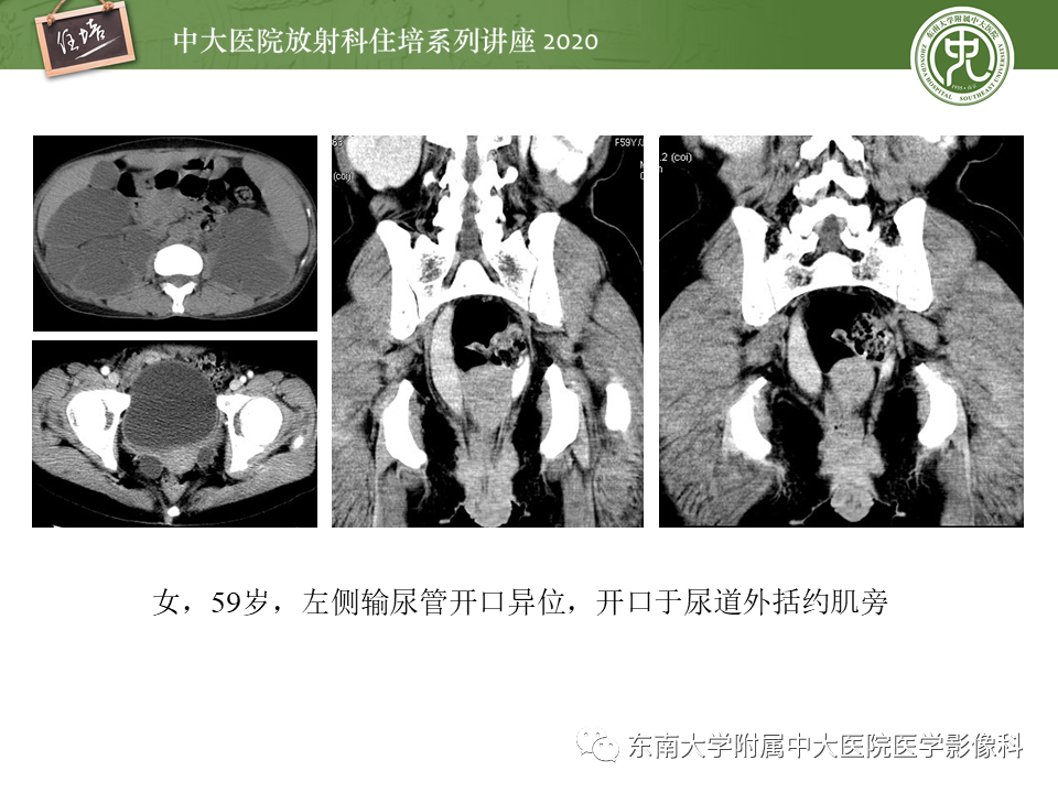 影像PPT - 【PPT】泌尿系统先天发育异常的影像表现-42