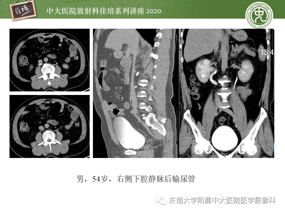 影像PPT - 【PPT】泌尿系统先天发育异常的影像表现-46