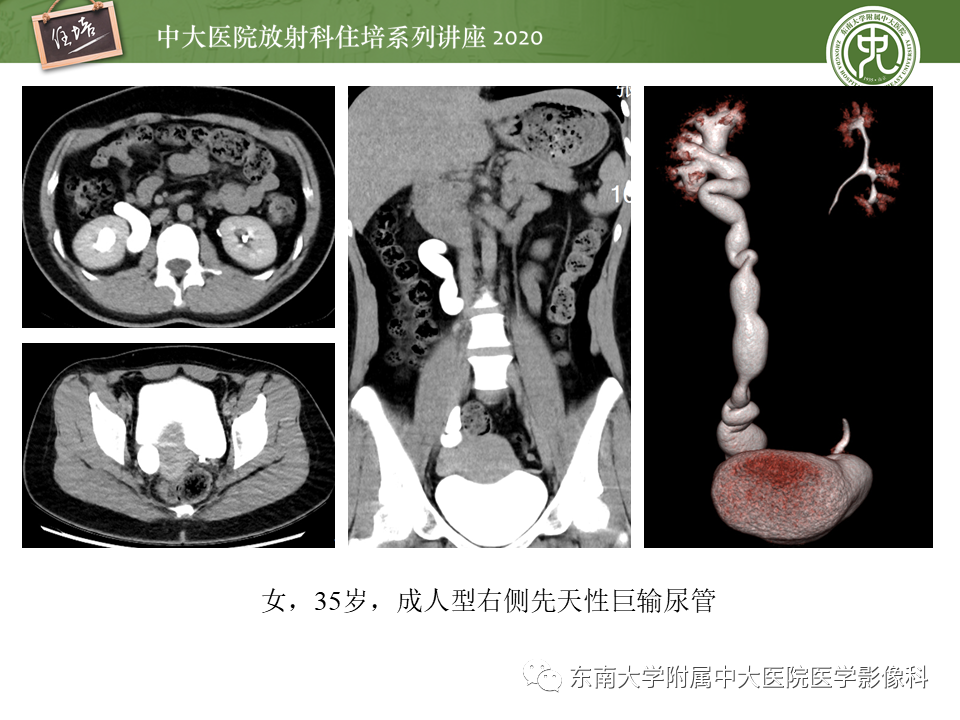 影像PPT - 【PPT】泌尿系统先天发育异常的影像表现-48