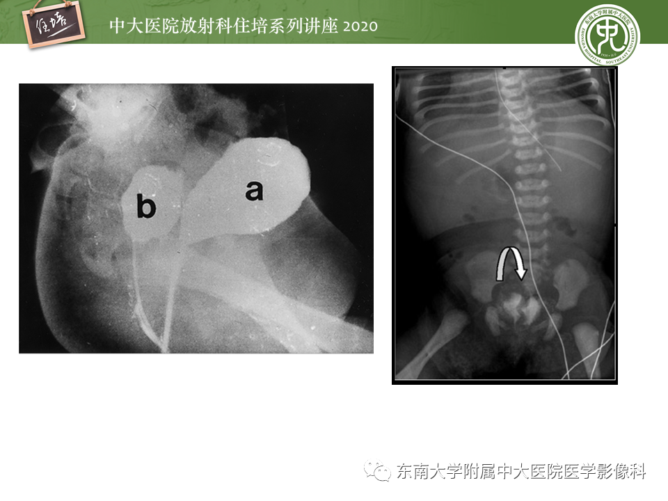 影像PPT - 【PPT】泌尿系统先天发育异常的影像表现-51
