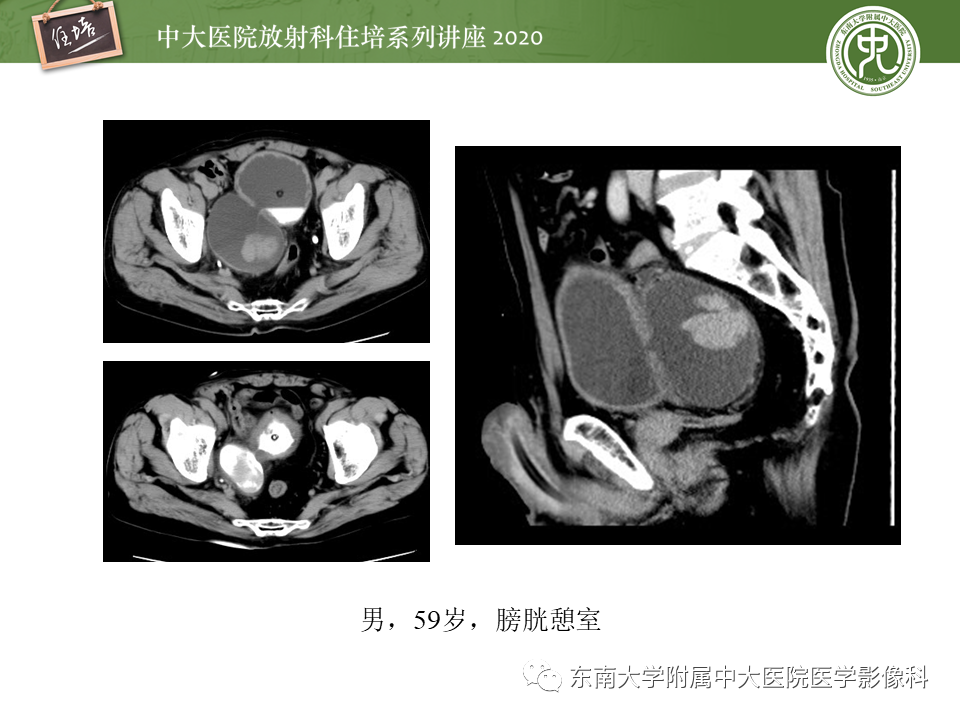 影像PPT - 【PPT】泌尿系统先天发育异常的影像表现-53