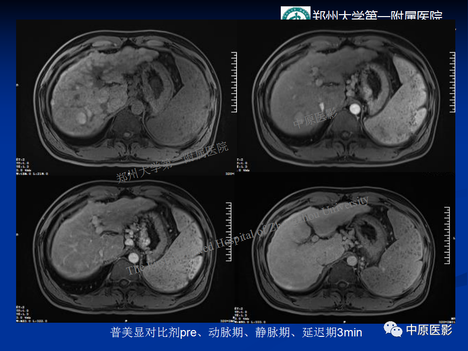 影像PPT - 【病例】肝脏结节性肝硬化1例MR影像-5
