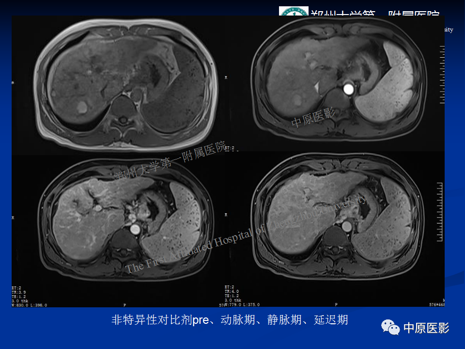 影像PPT - 【病例】肝脏结节性肝硬化1例MR影像-4