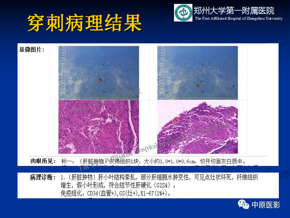 影像PPT - 【病例】肝脏结节性肝硬化1例MR影像-8