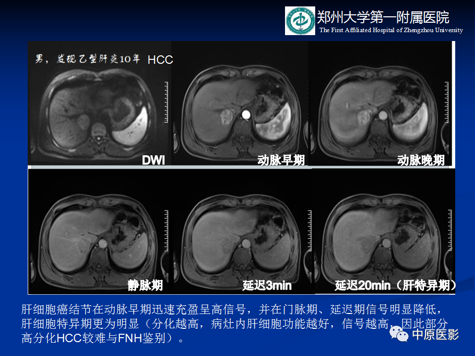 影像PPT - 【病例】肝脏结节性肝硬化1例MR影像-12